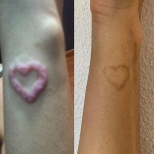 Eliminar tatuajes - Eliminación tatuaje por alergia a la tinta