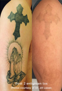 Eliminar tatuajes - Eliminación de tatuajes en Pamplona (Iruña)